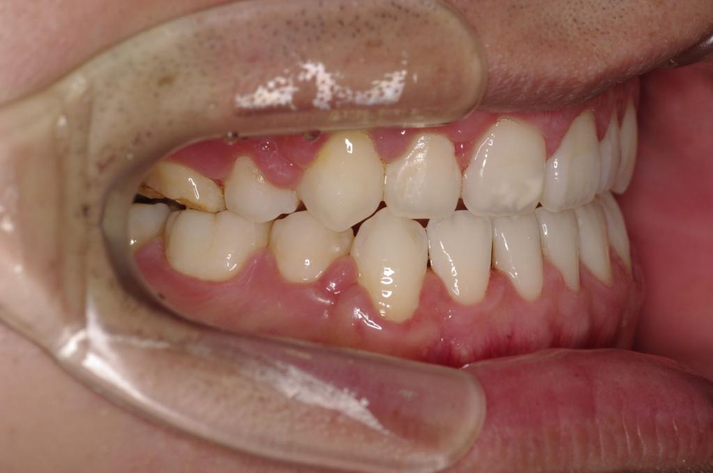 前歯、出っ歯・開咬の矯正治療後口内写真NO.981