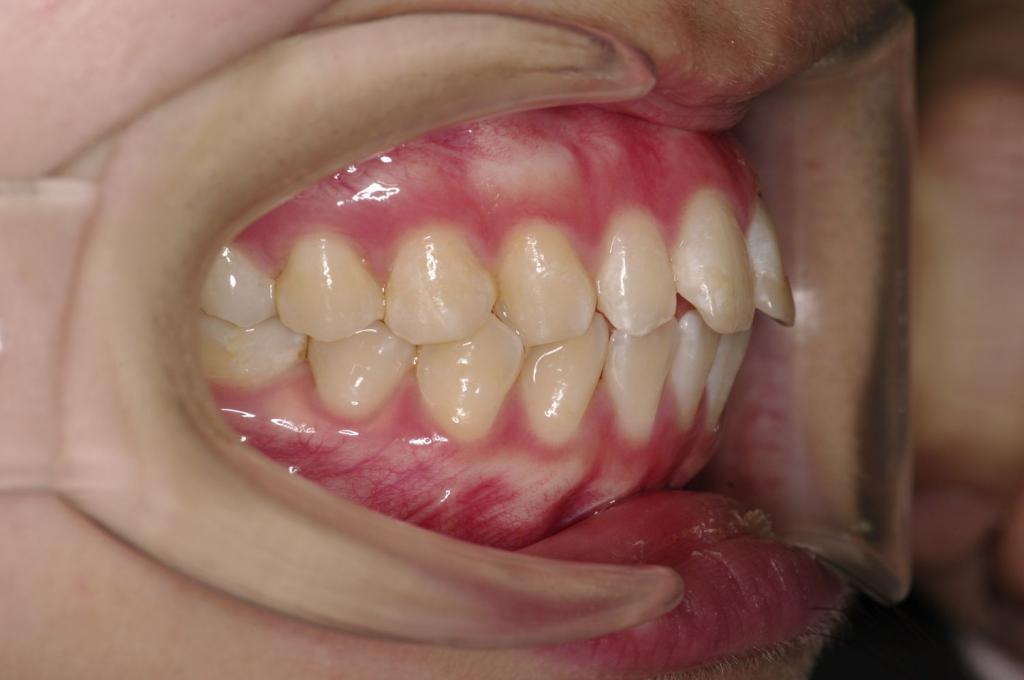 前歯、出っ歯・開咬の矯正治療前口内写真NO.982