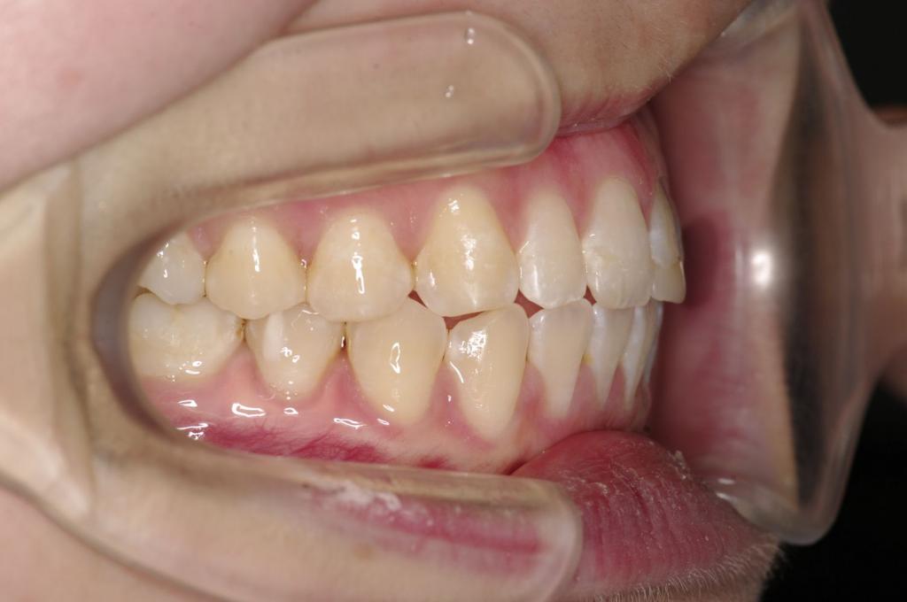 前歯、出っ歯・開咬の矯正治療後口内写真NO.982