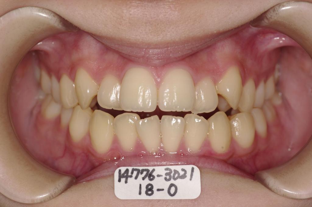 前歯、出っ歯・開咬の矯正治療前口内写真NO.983