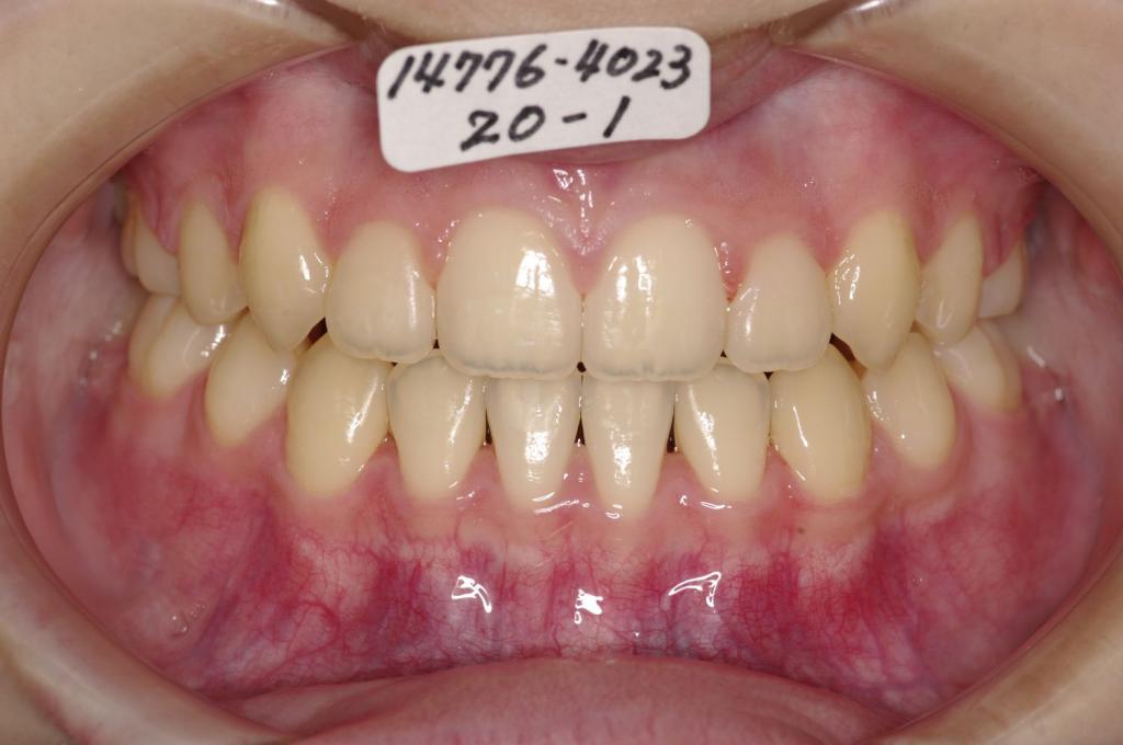 前歯、出っ歯・開咬の矯正治療後口内写真NO.983