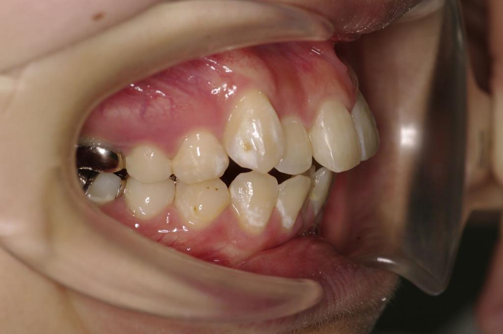 前歯、出っ歯・開咬の矯正治療前口内写真NO.984