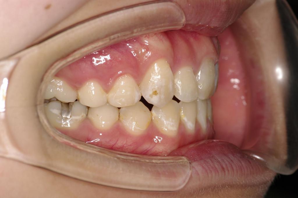 前歯、出っ歯・開咬の矯正治療後口内写真NO.984