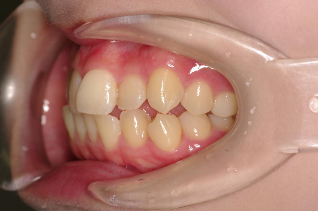 前歯、出っ歯・開咬の矯正治療前口内写真NO.985