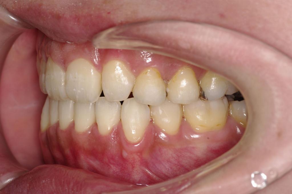 前歯、出っ歯・開咬の矯正治療後口内写真NO.986