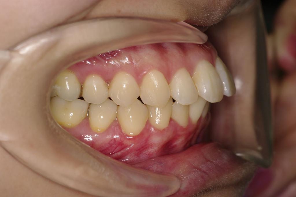 前歯、出っ歯・開咬の矯正治療前口内写真NO.989