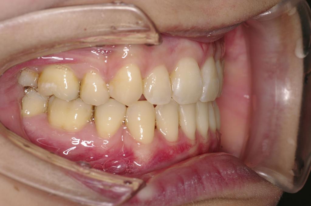 前歯、出っ歯・開咬の矯正治療後口内写真NO.989
