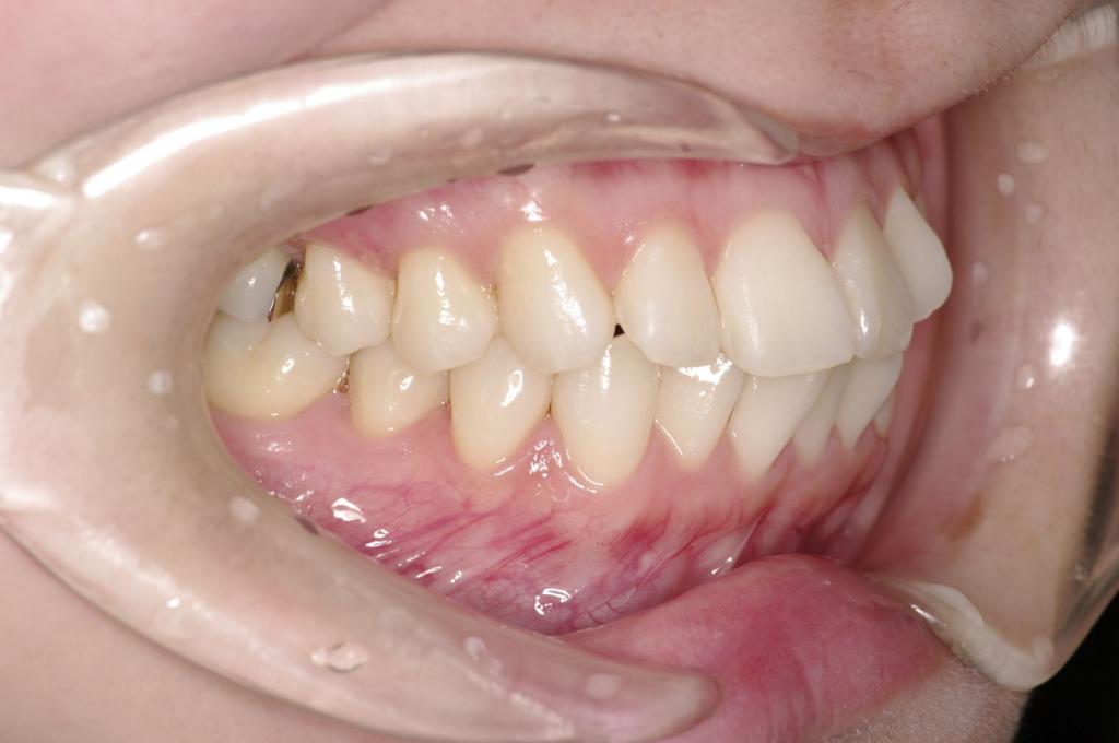 前歯、出っ歯・開咬の矯正治療前口内写真NO.996