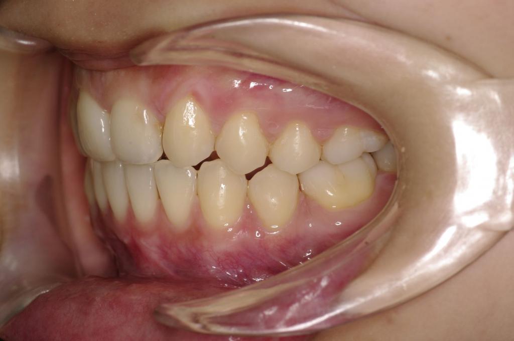 前歯、出っ歯・開咬の矯正治療後口内写真NO.997