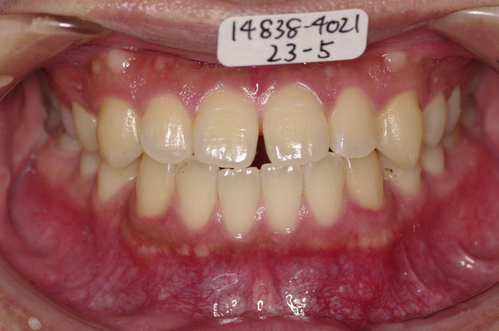 前歯、出っ歯・開咬の矯正治療前口内写真NO.998