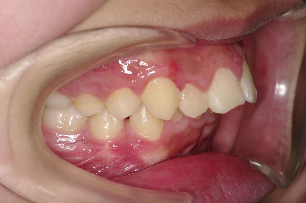 前歯、出っ歯・開咬の矯正治療後口内写真NO.999