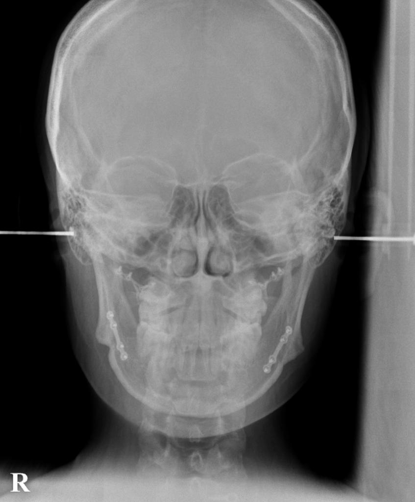 顎、顔の歪みの矯正治療後口内写真NO.395