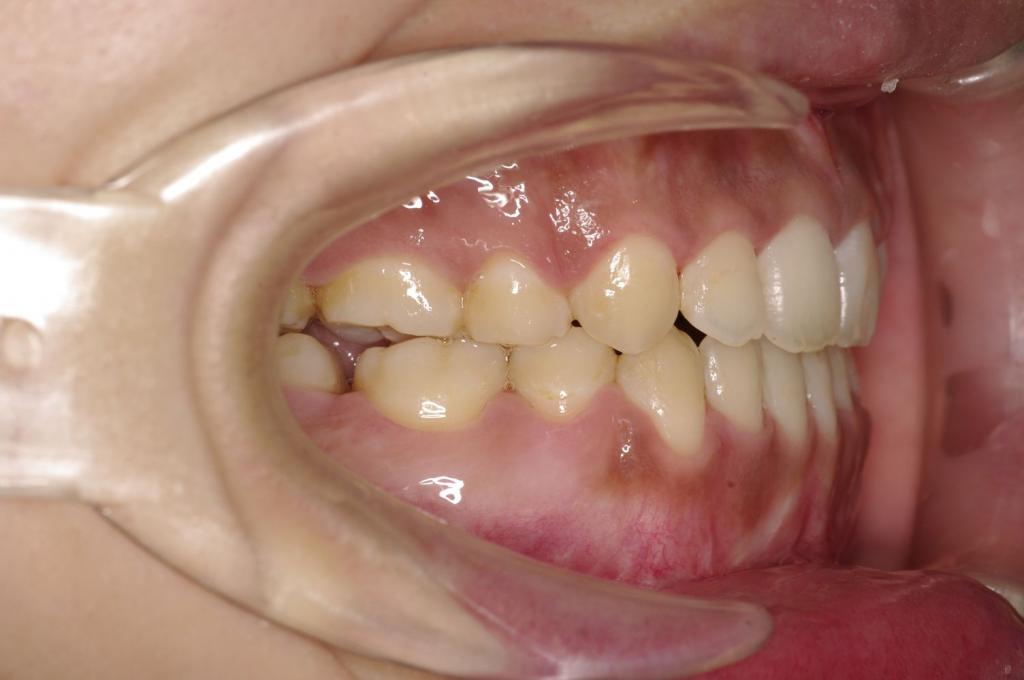 顎、顔の歪みの矯正治療後口内写真NO.405