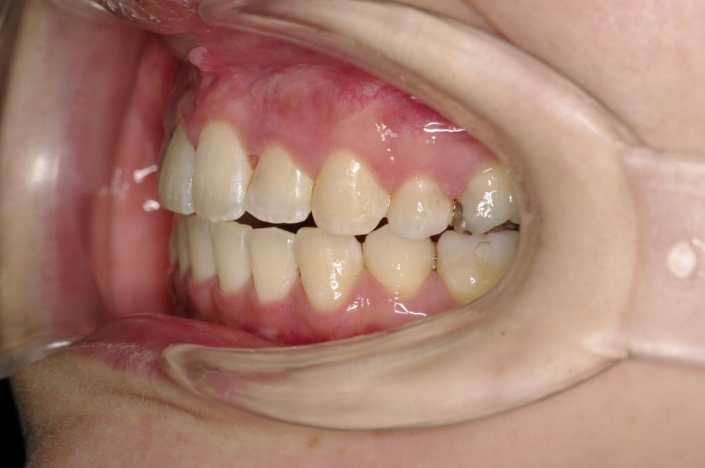 顎、顔の歪みの矯正治療後口内写真NO.406