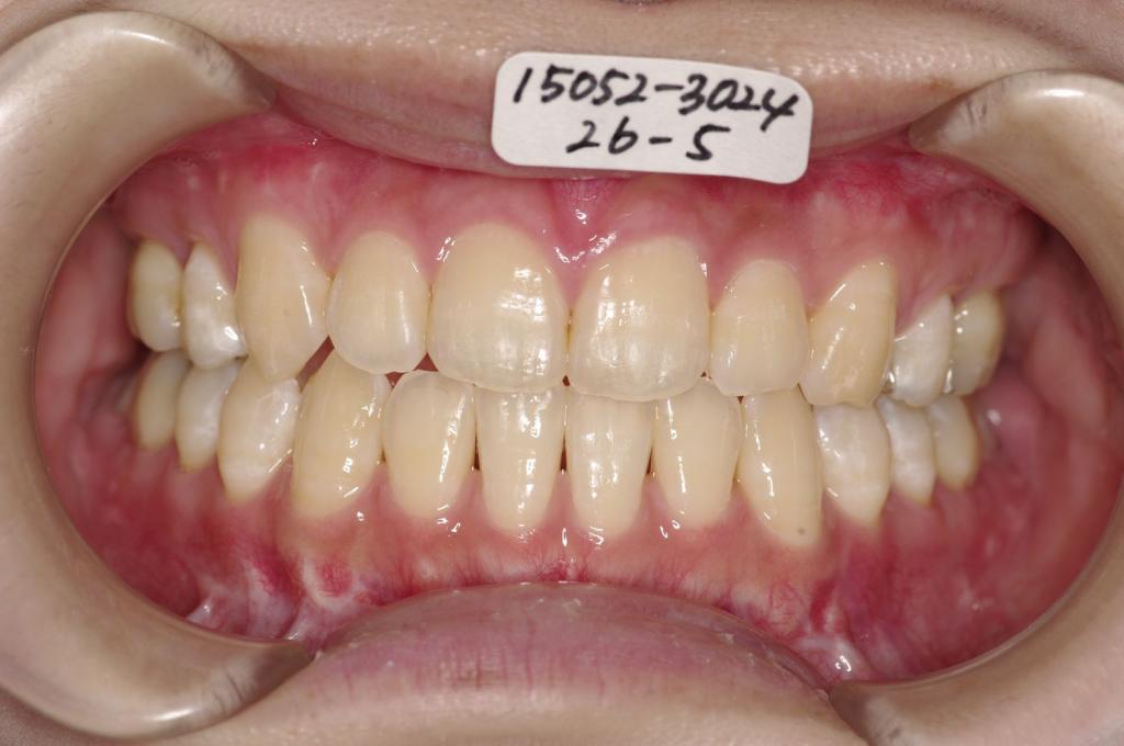 顎、顔の歪みの矯正治療後口内写真NO.407