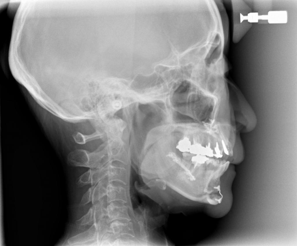 顎、顔の歪みの矯正治療後口内写真NO.408