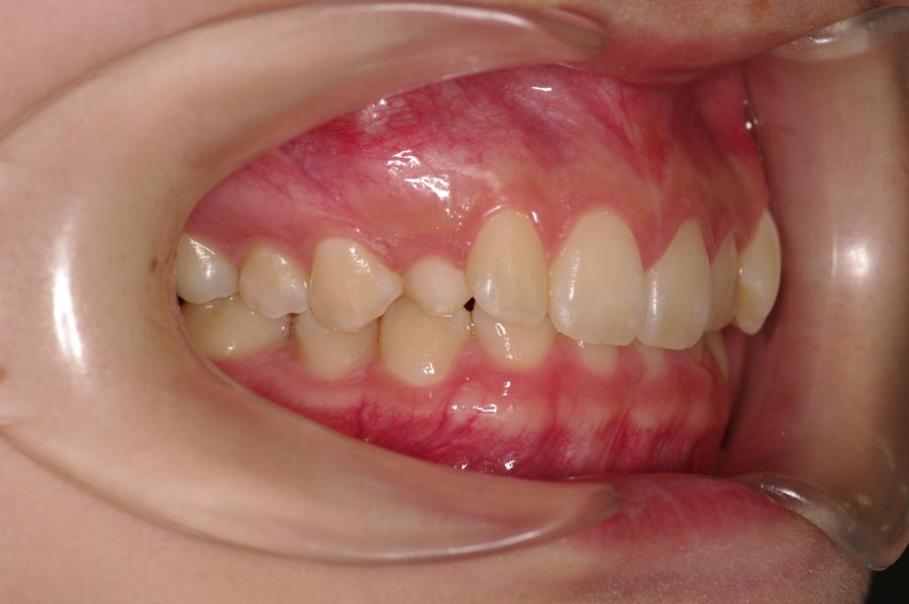 歯欠損の矯正治療前口内写真NO.100