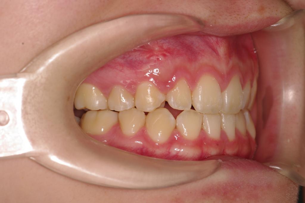 歯欠損の矯正治療後口内写真NO.100
