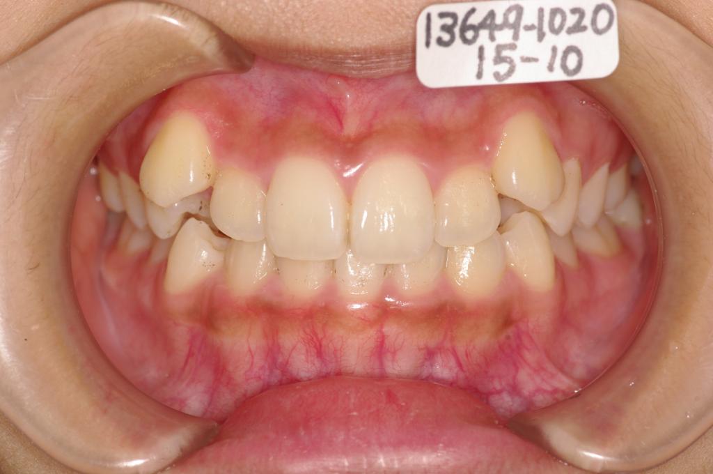 歯欠損の矯正治療前口内写真NO.101