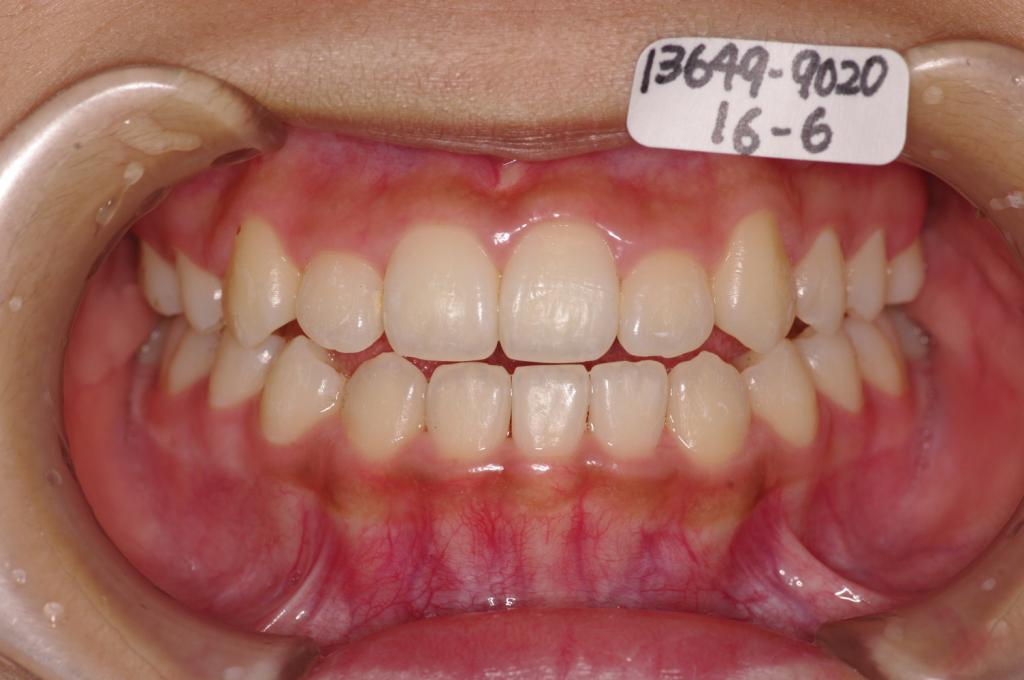 歯欠損の矯正治療後口内写真NO.101