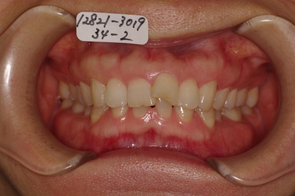 歯欠損の矯正治療前口内写真NO.102