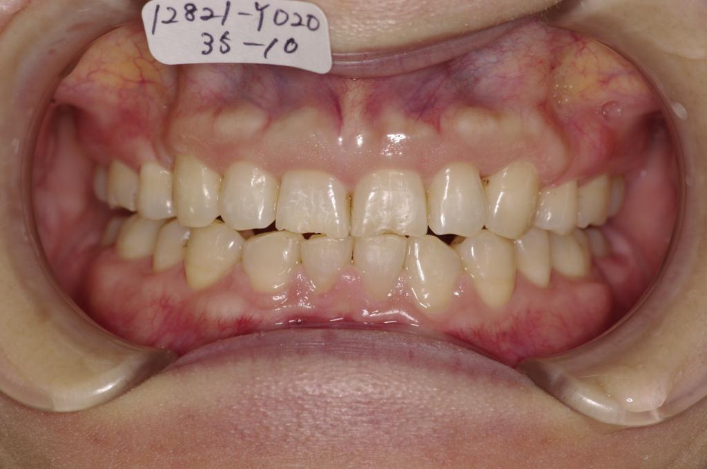 歯欠損の矯正治療後口内写真NO.102