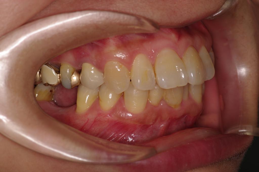 歯欠損の矯正治療前口内写真NO.103