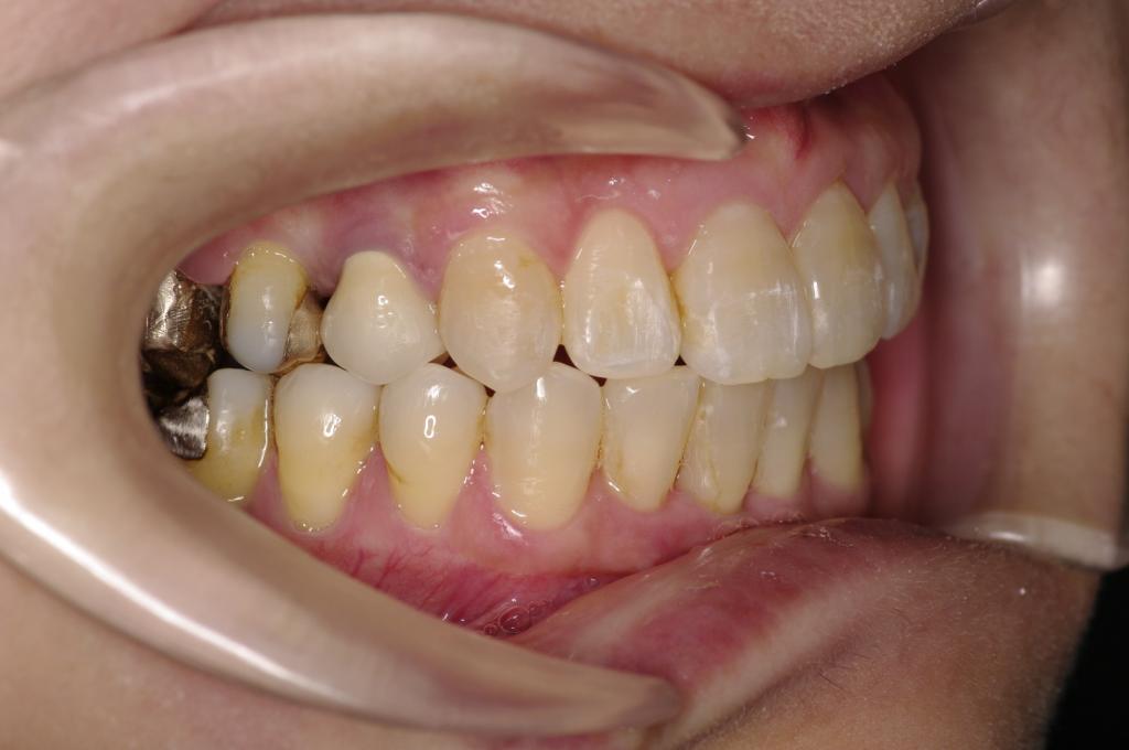 歯欠損の矯正治療後口内写真NO.103