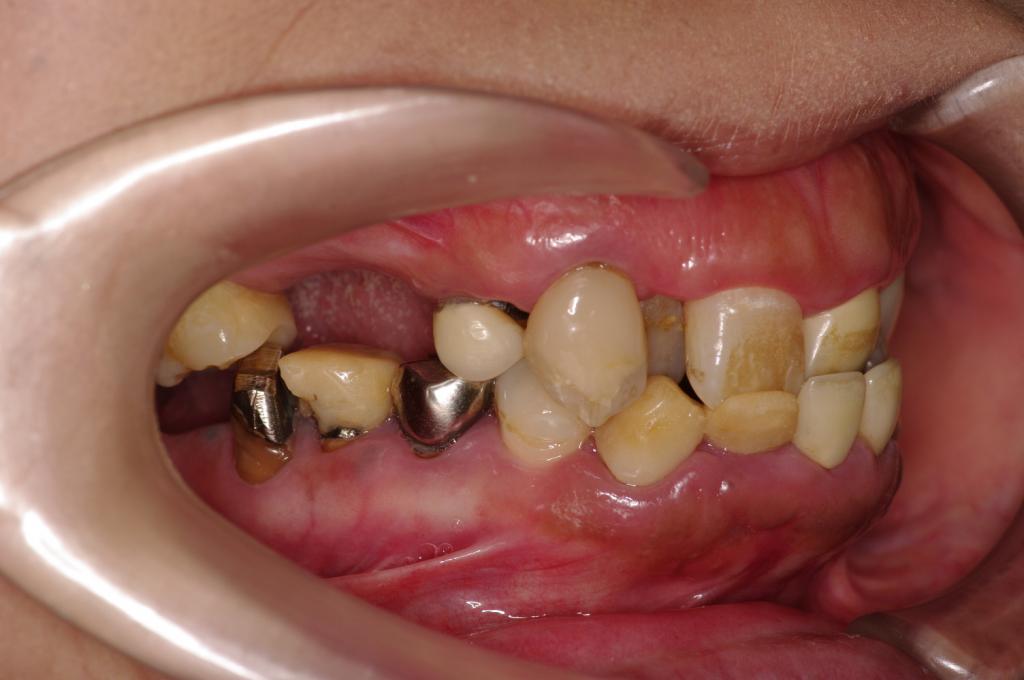 歯欠損の矯正治療前口内写真NO.104