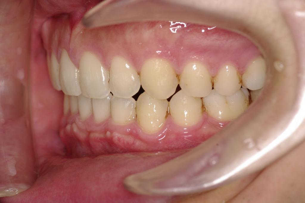 歯欠損の矯正治療後口内写真NO.105