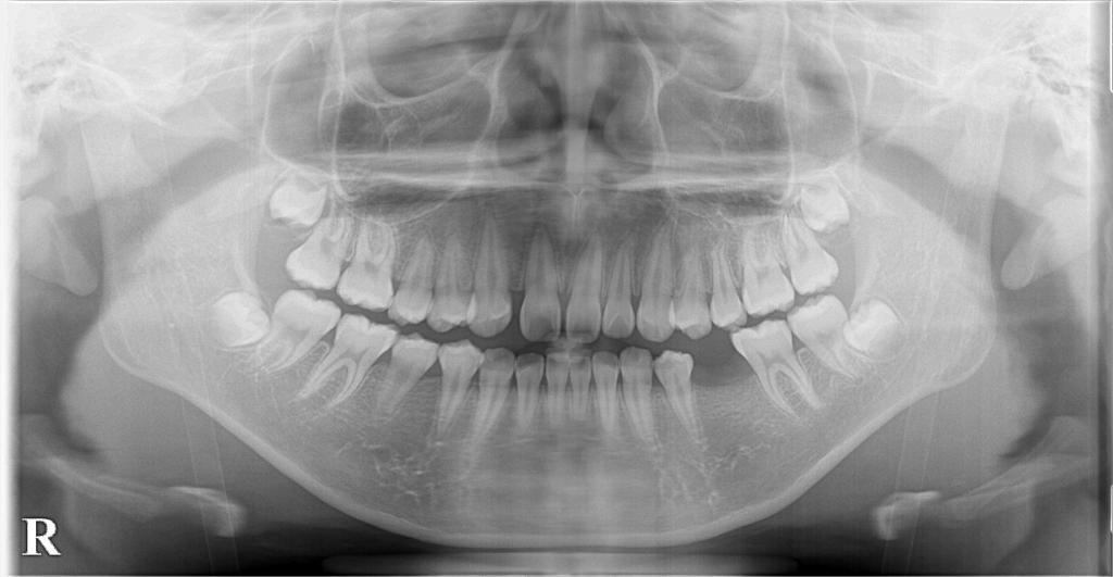 歯欠損の矯正治療前口内写真NO.106
