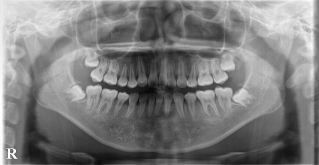 歯欠損の矯正治療後口内写真NO.106