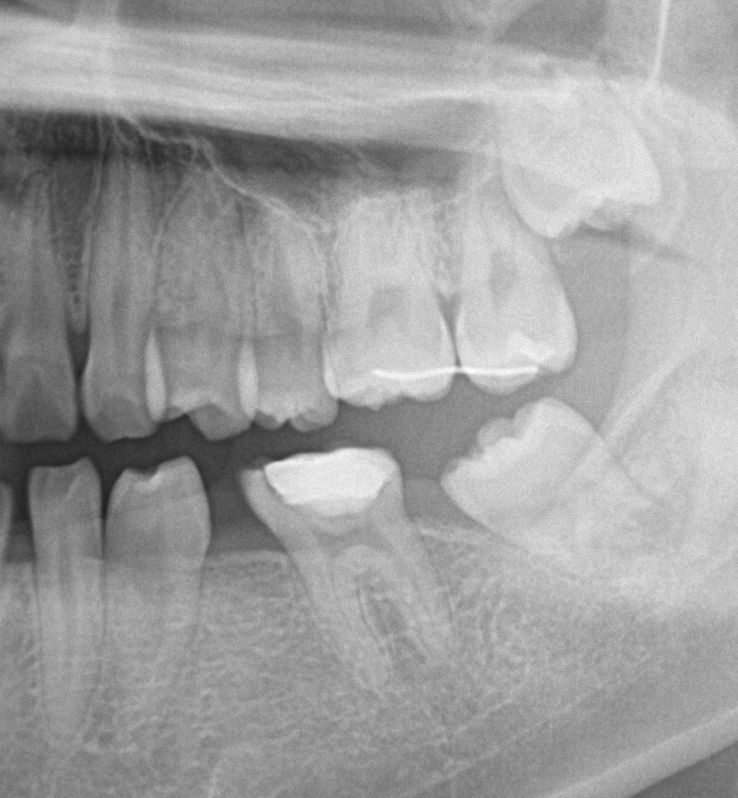 歯欠損の矯正治療前口内写真NO.107