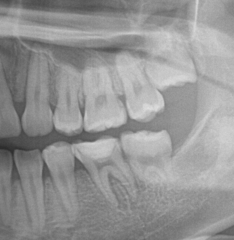 歯欠損の矯正治療後口内写真NO.107