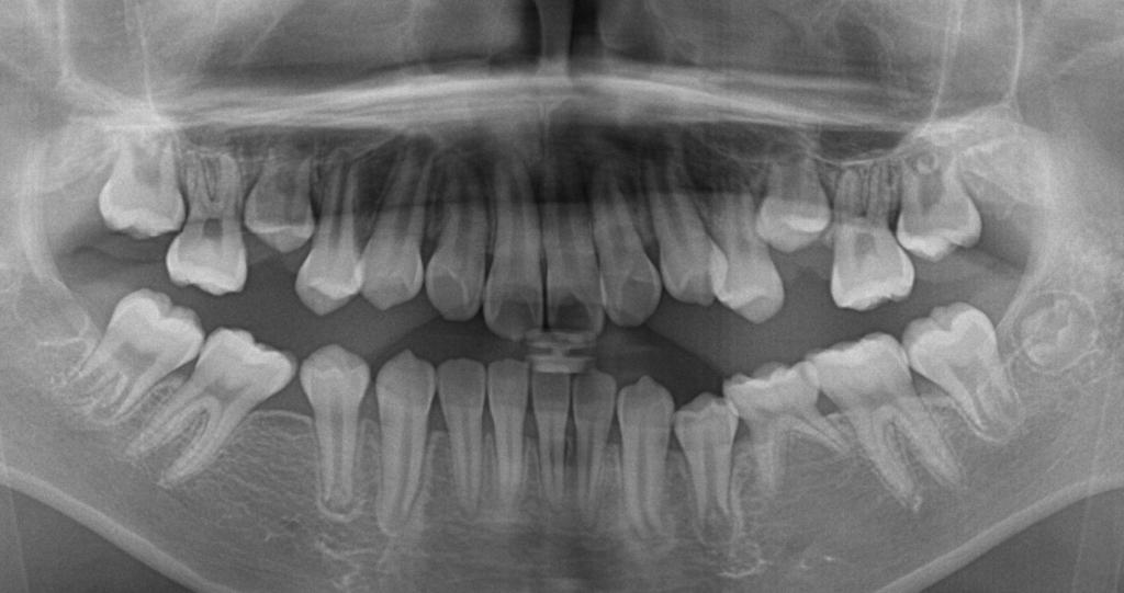 歯欠損の矯正治療前口内写真NO.108