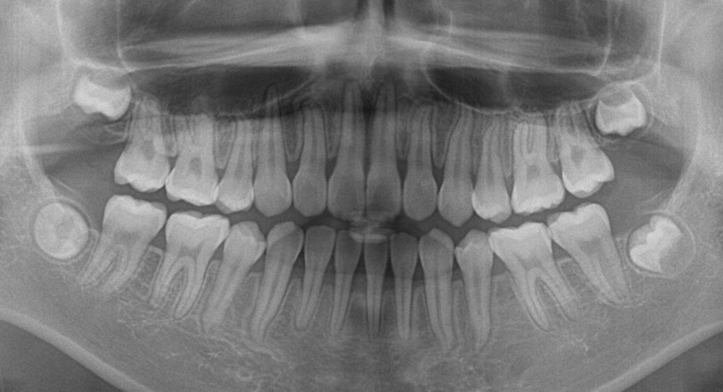 歯欠損の矯正治療後口内写真NO.108