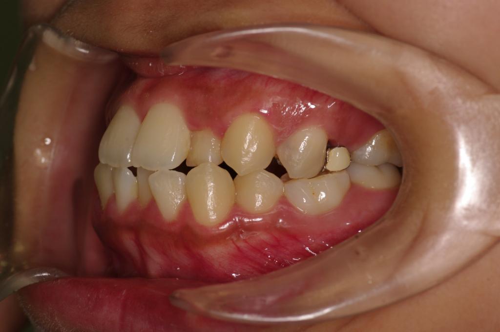 歯欠損の矯正治療前口内写真NO.109