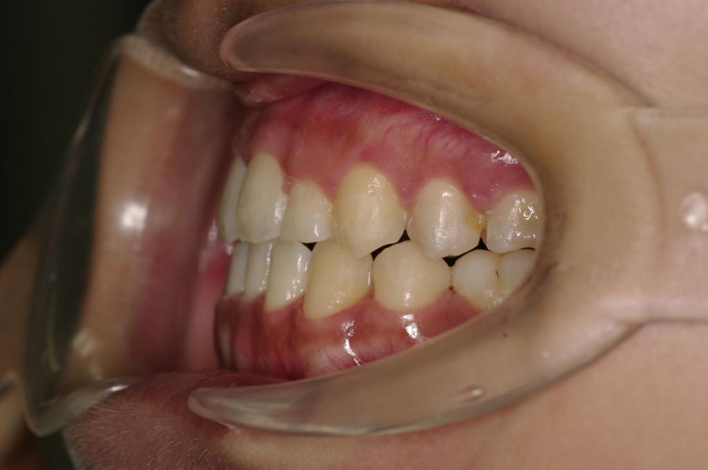 歯欠損の矯正治療後口内写真NO.109