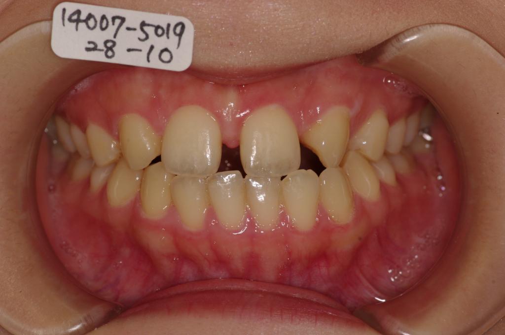 歯欠損の矯正治療前口内写真NO.110