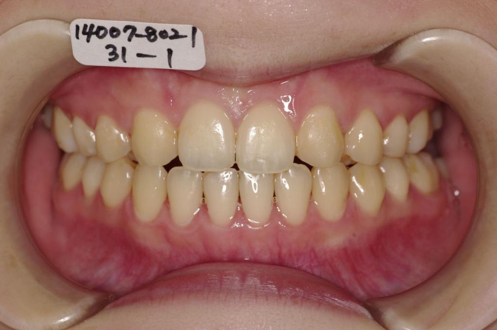 歯欠損の矯正治療後口内写真NO.110