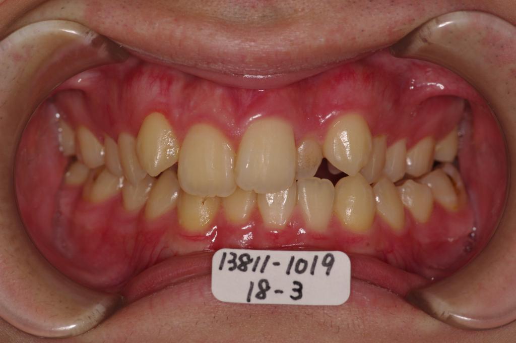 歯欠損の矯正治療前口内写真NO.111