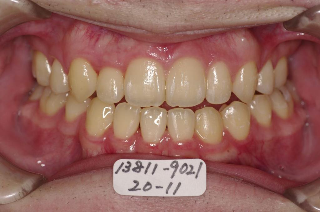 歯欠損の矯正治療後口内写真NO.111