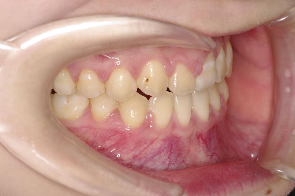 歯欠損の矯正治療後口内写真NO.115