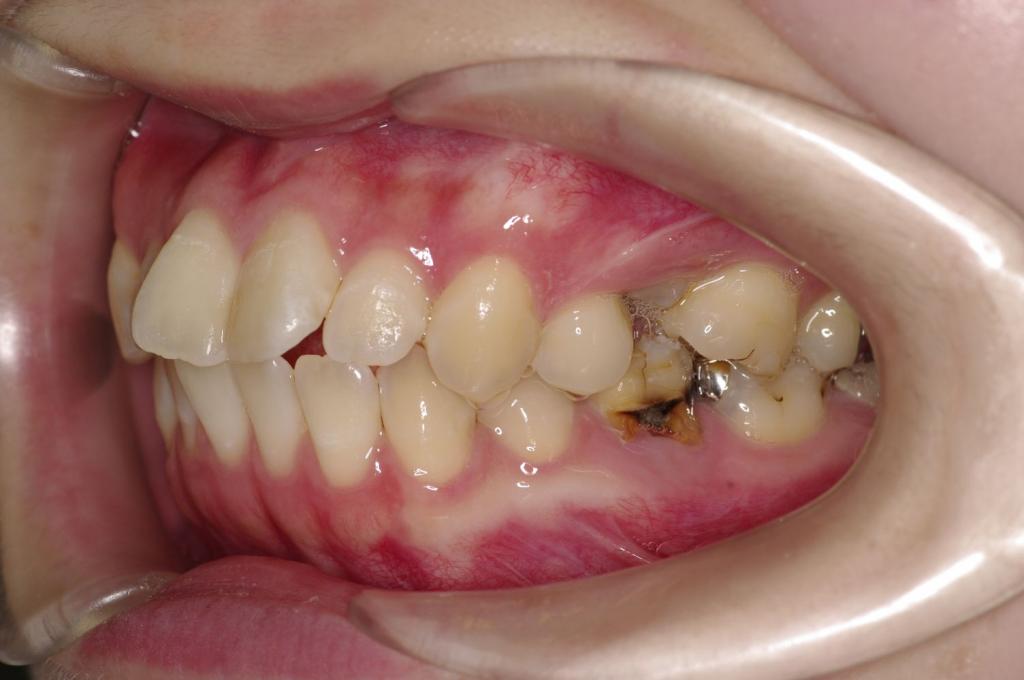 歯欠損の矯正治療前口内写真NO.120