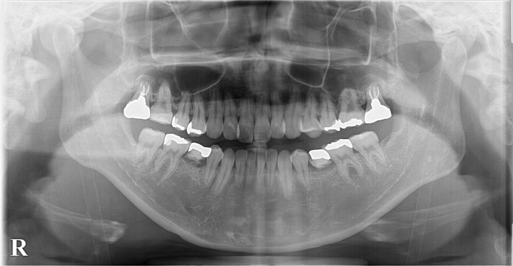 歯欠損の矯正治療前口内写真NO.124