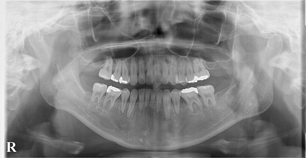 歯欠損の矯正治療後口内写真NO.124