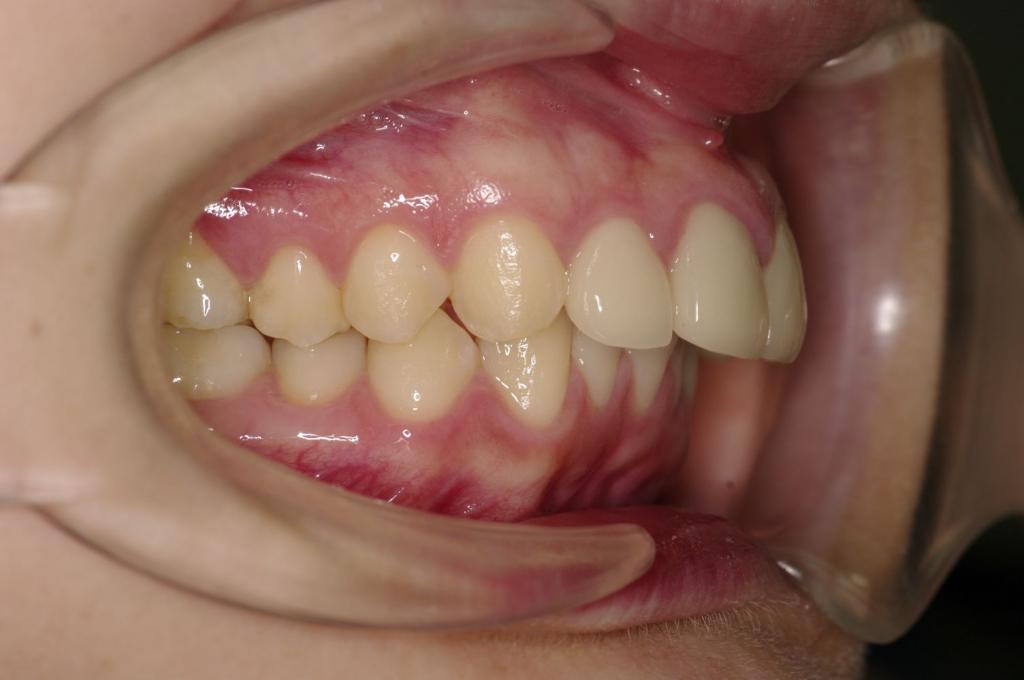 歯欠損の矯正治療前口内写真NO.126