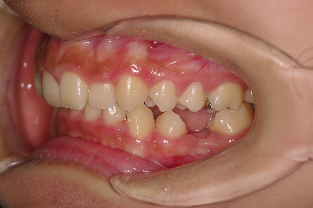 歯欠損の矯正治療前口内写真NO.79