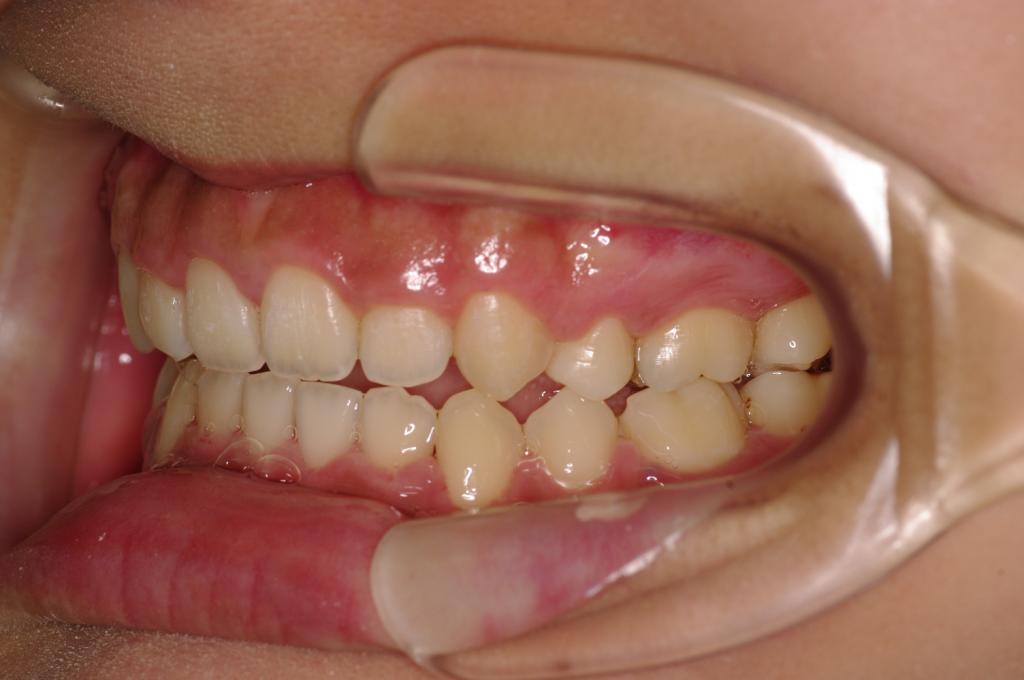 歯欠損の矯正治療後口内写真NO.79