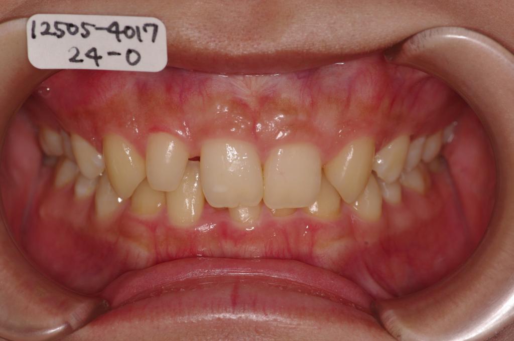 歯欠損の矯正治療前口内写真NO.80